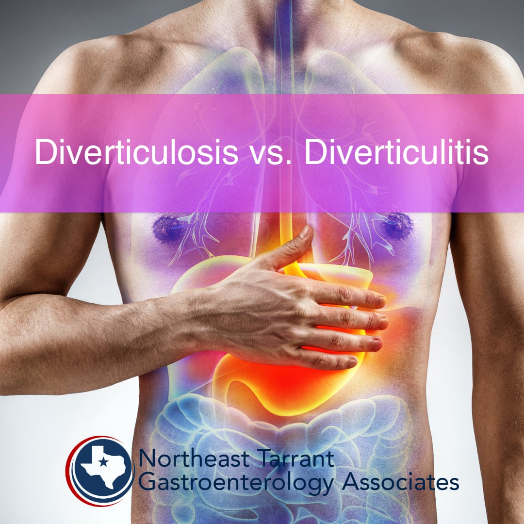 diverticulitis symptoms and causes