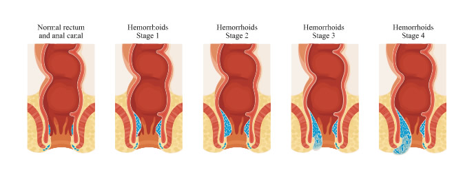 hemorrhoid Treatment 